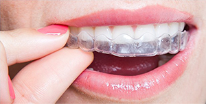 Removable Braces